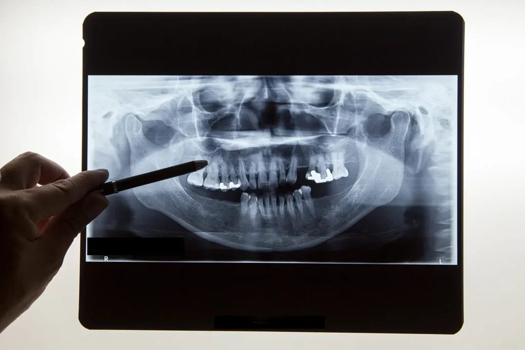 An X-ray image showing dental fillings in a patient's mouth, demonstrating the benefits of using Rubicare Health Savings Plans to save on dental treatments.